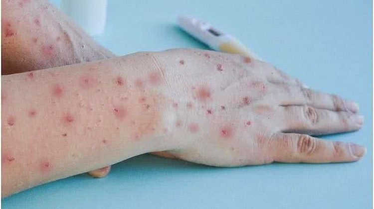 Bahia confirma primeiros dois casos de Mpox este ano; outros dois casos suspeitos seguem em análise